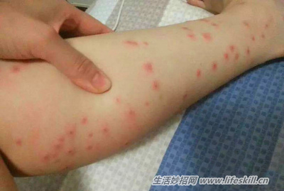 蠓虫叮咬比蚊凶狠,教你3招来防范